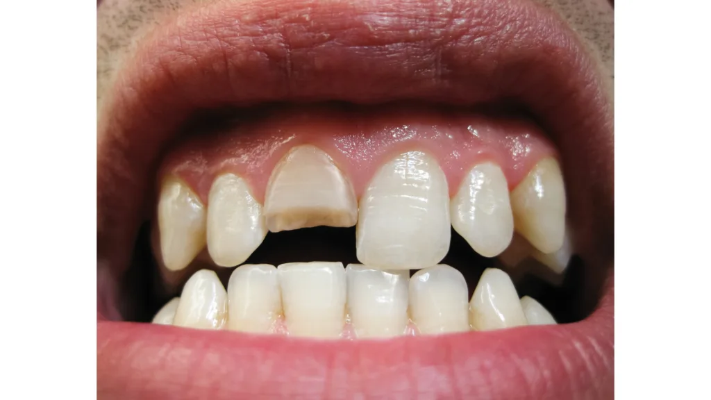 Une dent cassée