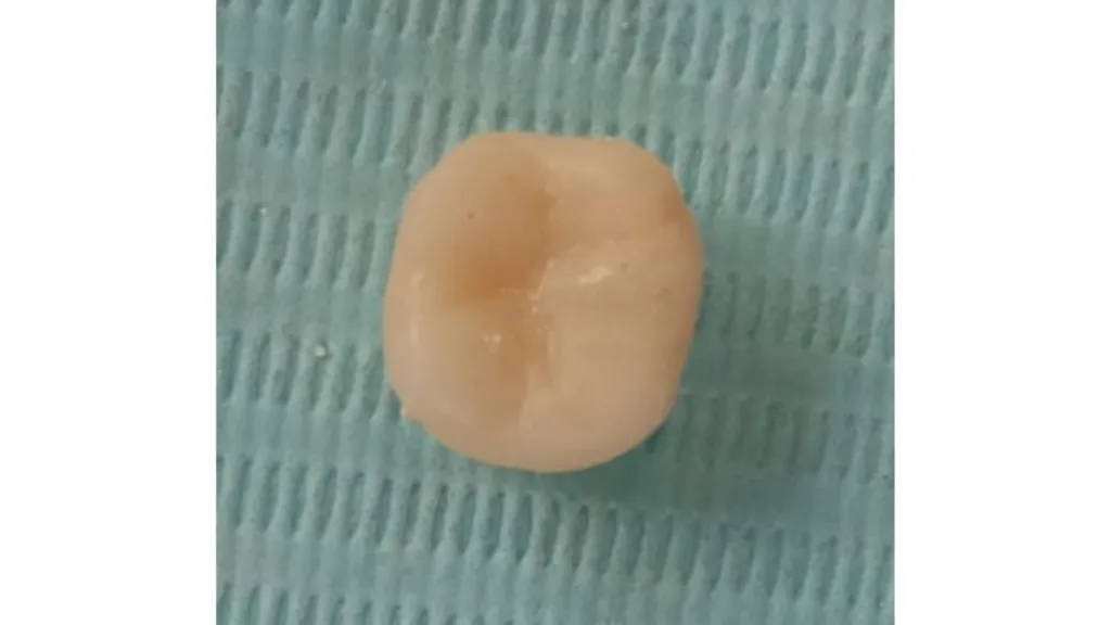 Couronne en résine