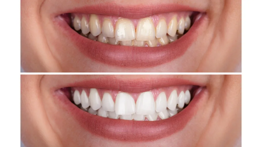 Blanchir des dents jaunies ou tachées