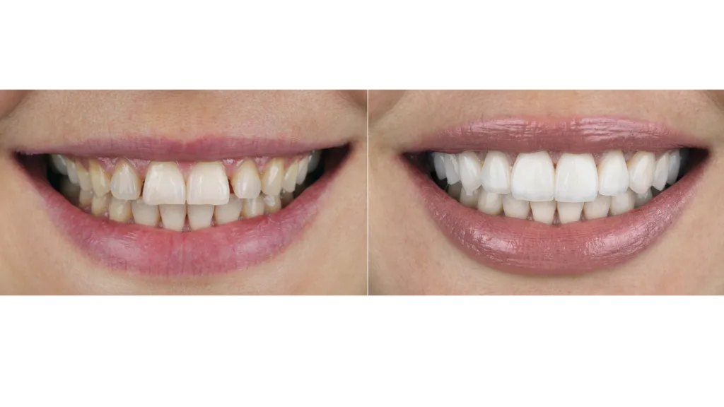 Masquer des écarts légers (diastèmes) ou des alignements imparfaits sans orthodontie