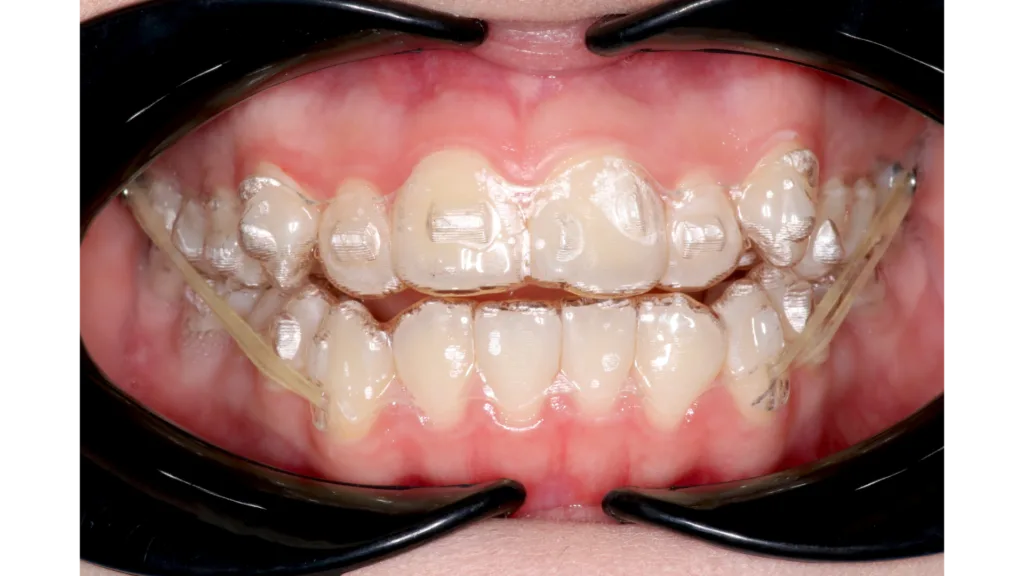 Gouttière orthodontique