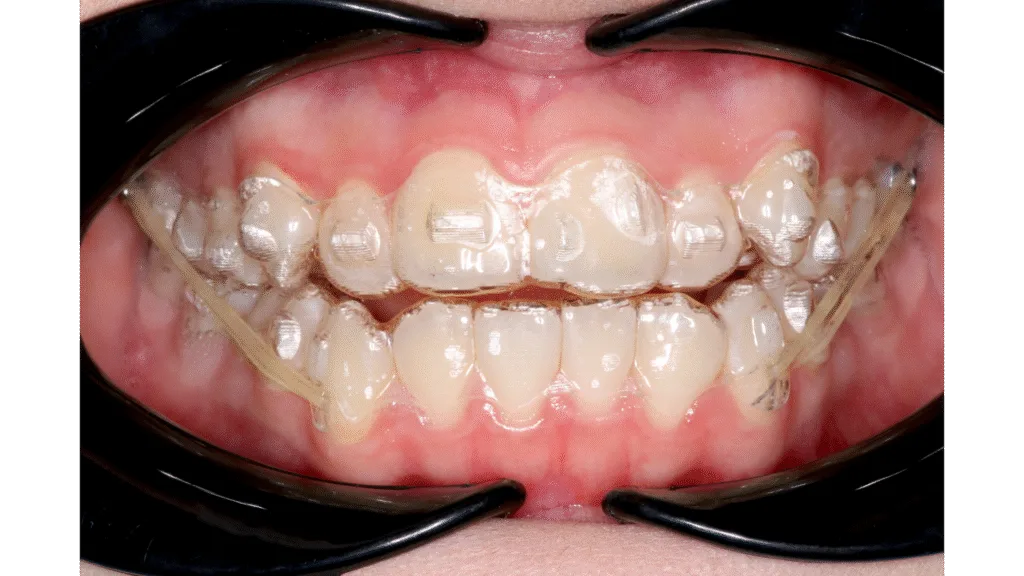 Appareil dentaire transparent (aligneurs invisibles)