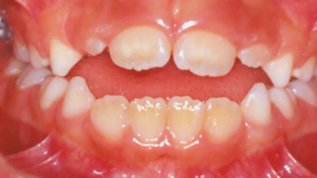 Béance est un écart entre les dents du haut et du bas