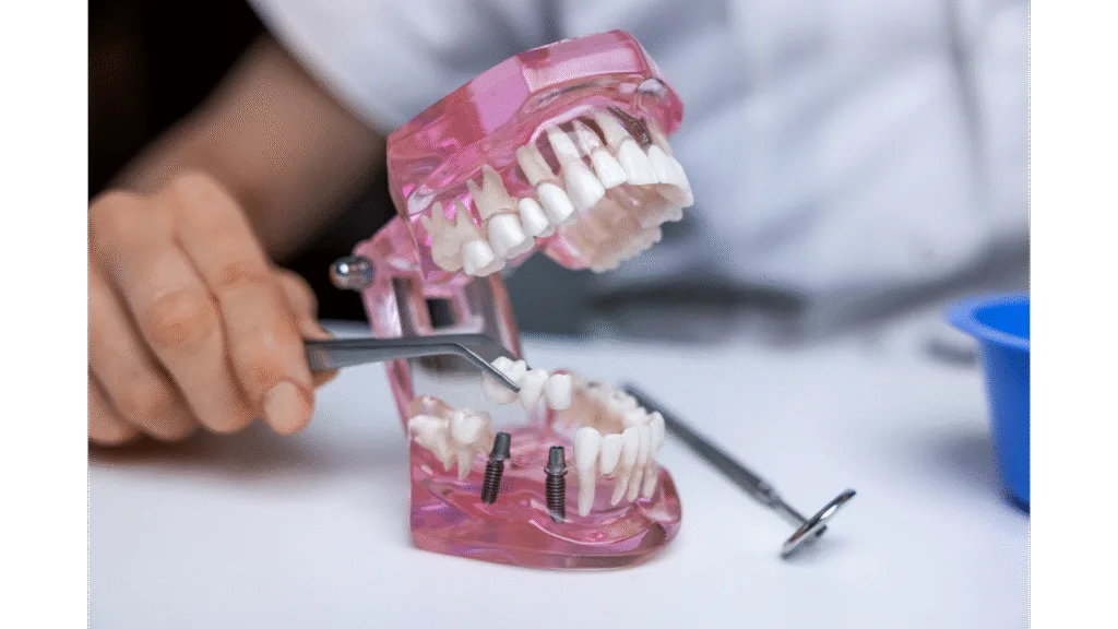 Bridge sur implant