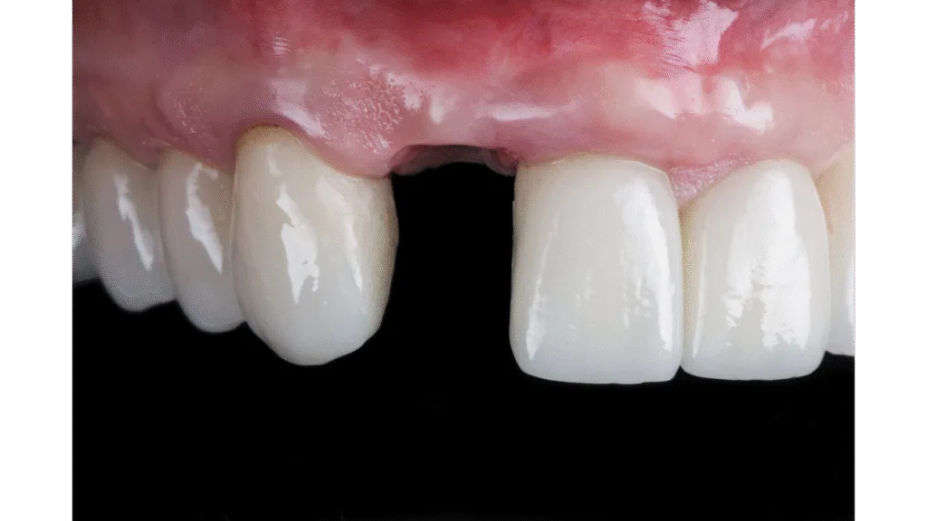 Remplacer une ou plusieurs dents absentes