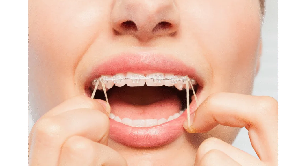 Autres appareils orthodontiques