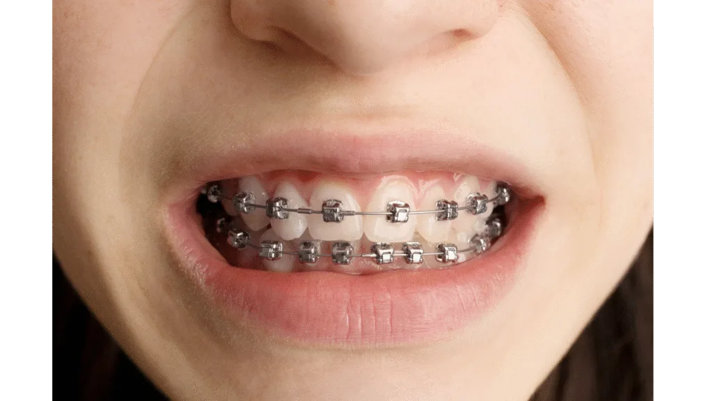 Bagues métalliques (multi-attaches)