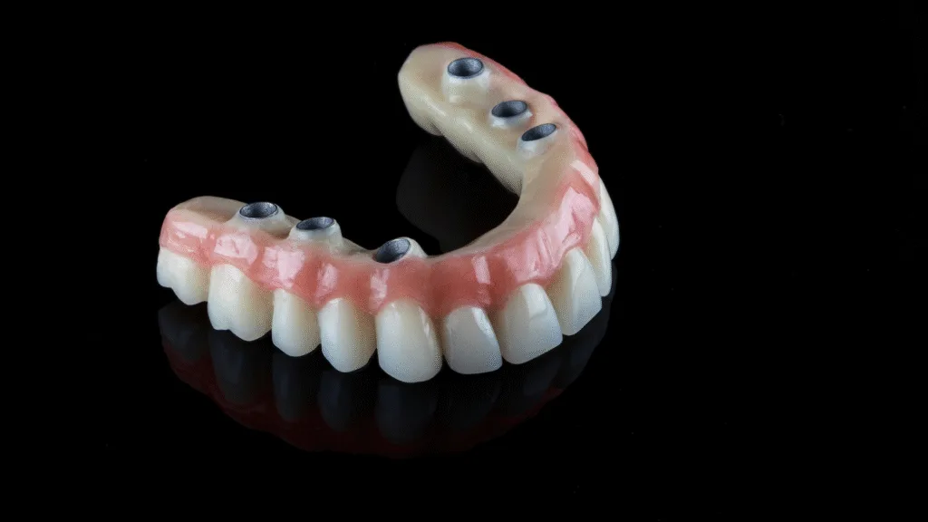 Bridges complets sur implants (All-on-4, All-on-6, All-on-8)