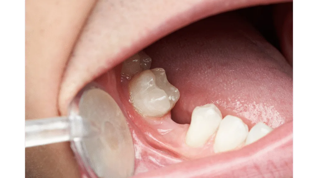 Préserver l’alignement des dents