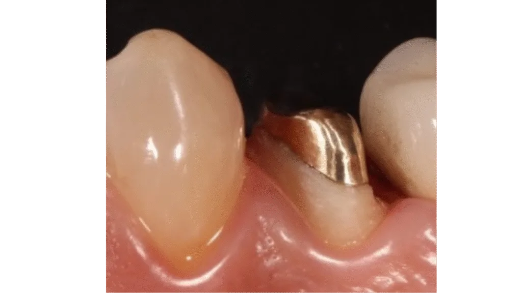 Inlay core VS Implant et Onlay