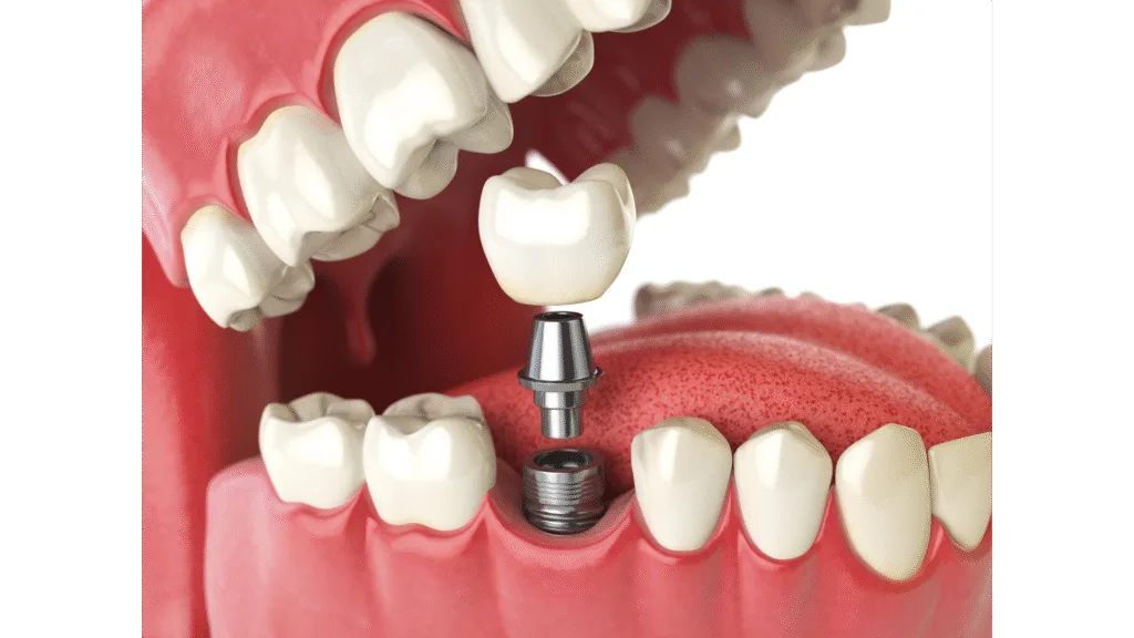 Inlay core vs Implant dentaire