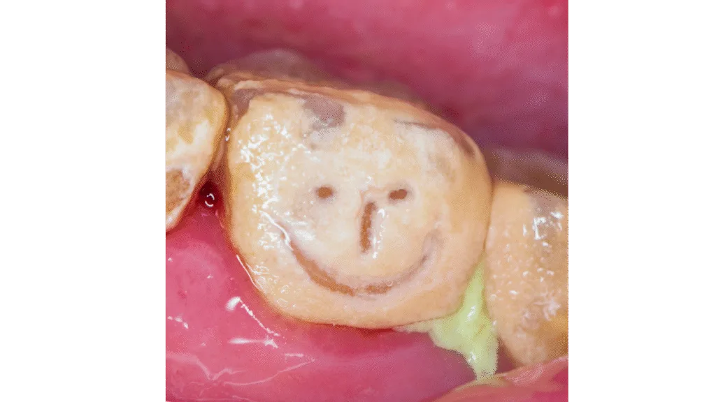 Caries et infections