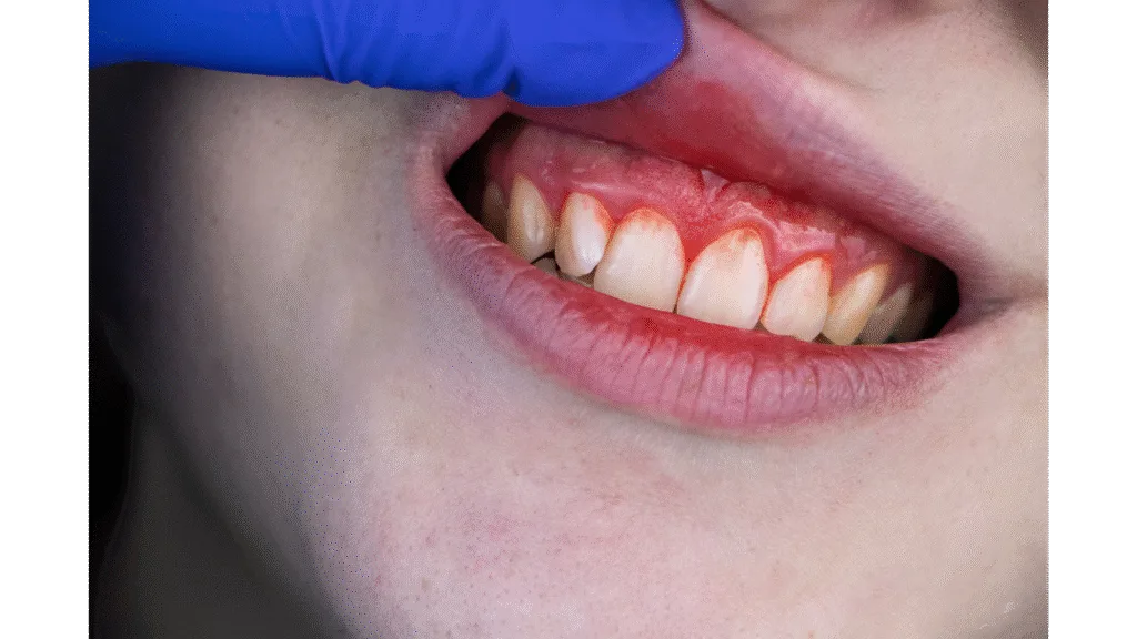 La gingivite : Une alerte précoce