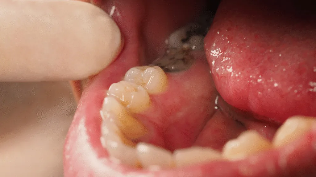 Caries dentaires