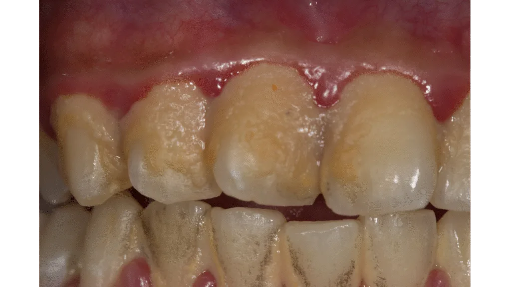 Pourquoi le tartre se forme-t-il ?Hygiène insuffisante