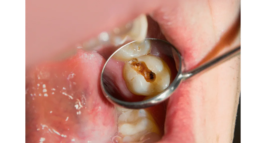 Caries profondes