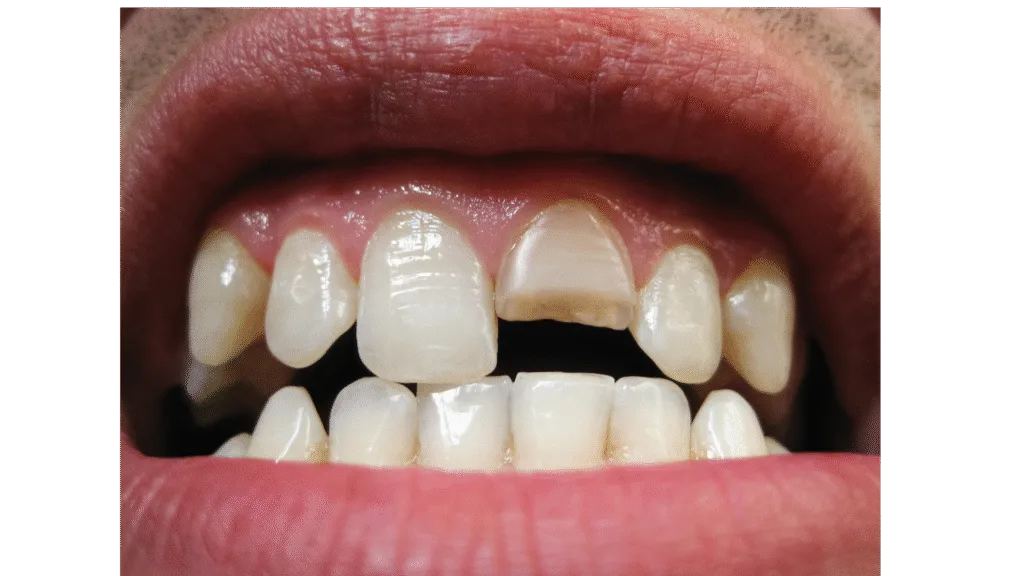 Fracture de la dentine