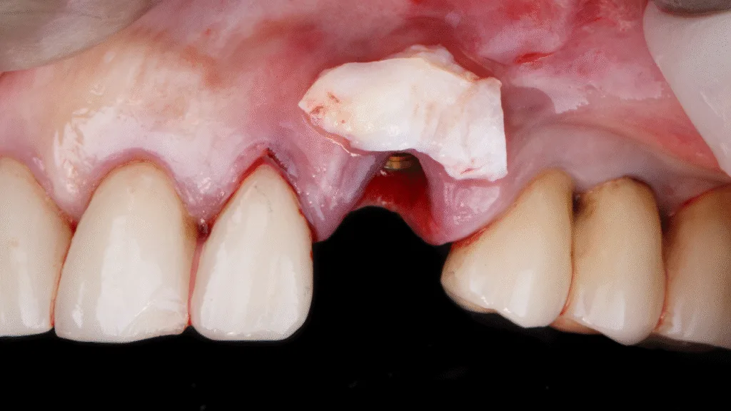Préparation aux implants