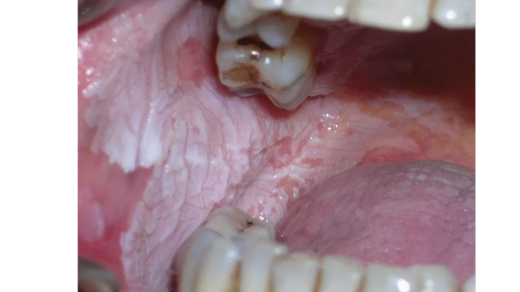 Leucoplasie