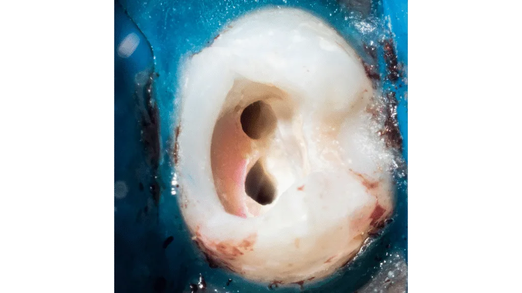 Accès et nettoyage des dents