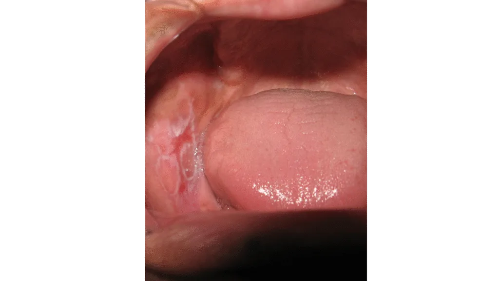 Lichen plan oral