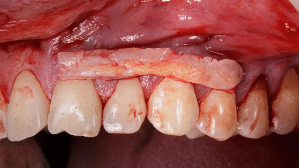 Greffes gingivales