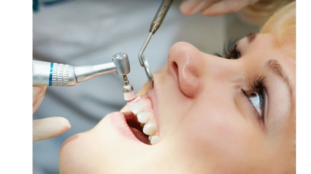 Polissage d'un détartrage des dents