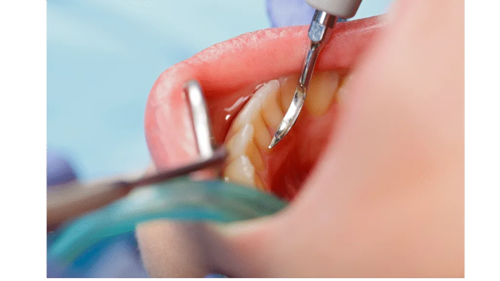 Détartrage supra-gingival