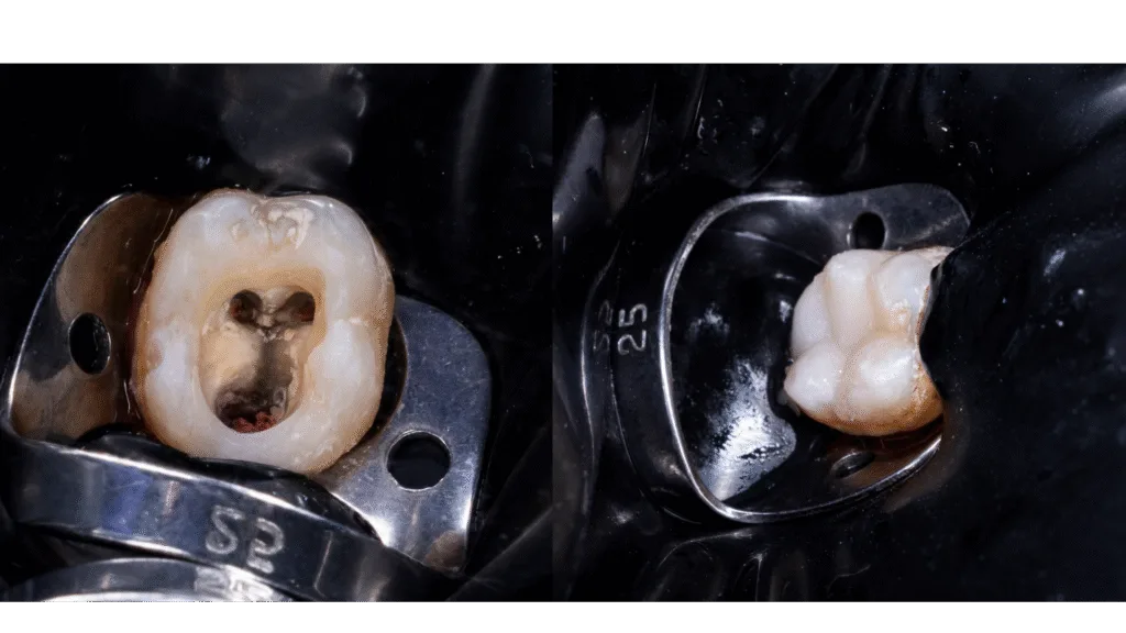 Restauration finale des dents