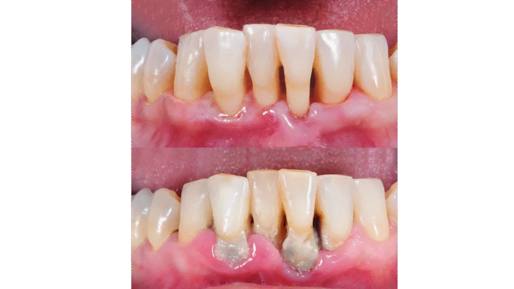 Détartrage des dents avant et après