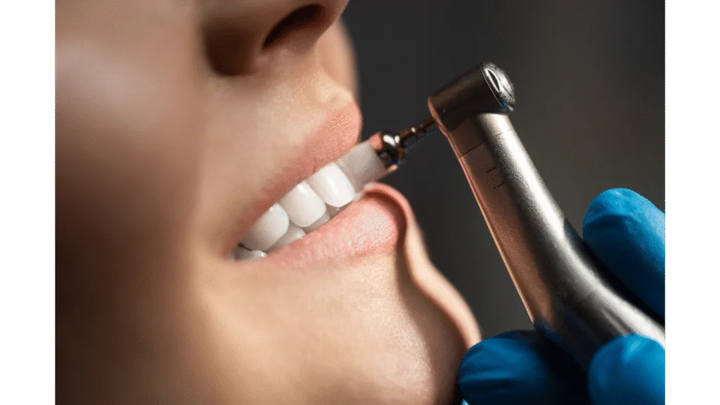 Détartrage supra-gingival