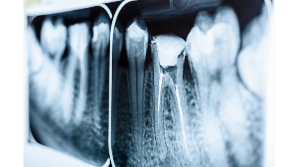 Retraitement endodontique