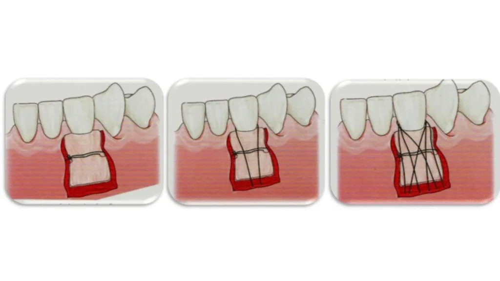 Greffe gingivale libre (ou épithélioconjonctive)